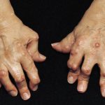 mani-artrite-reumatoide